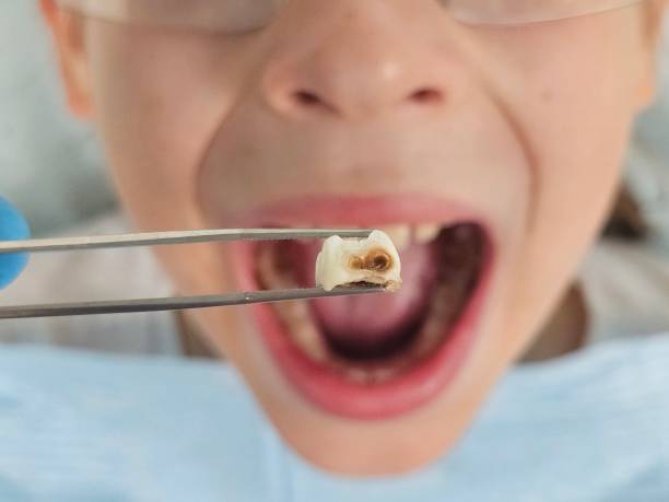 Best Emergency Tooth Extraction in Madisonville, KY
